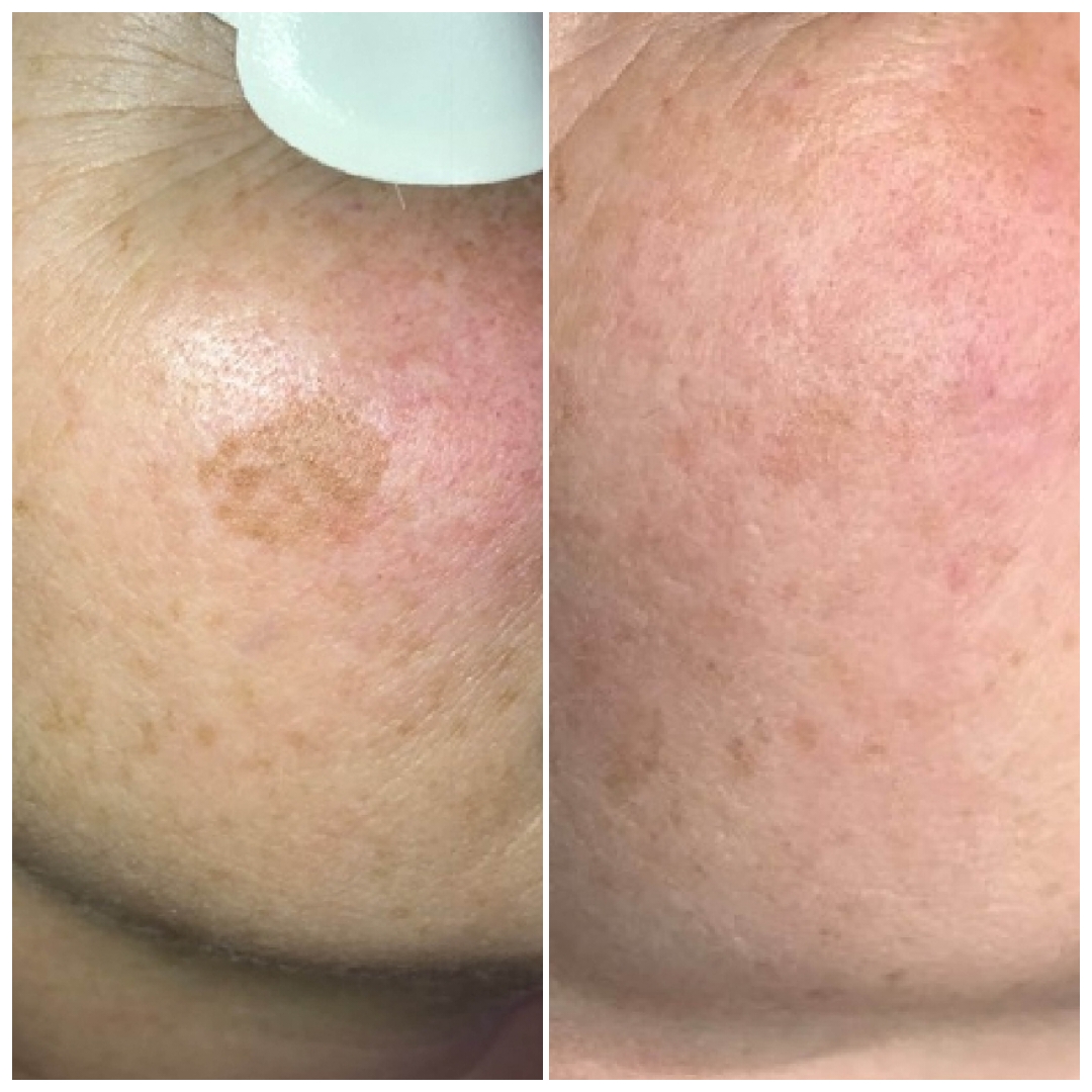Laser Pigmentation Removal Treatment