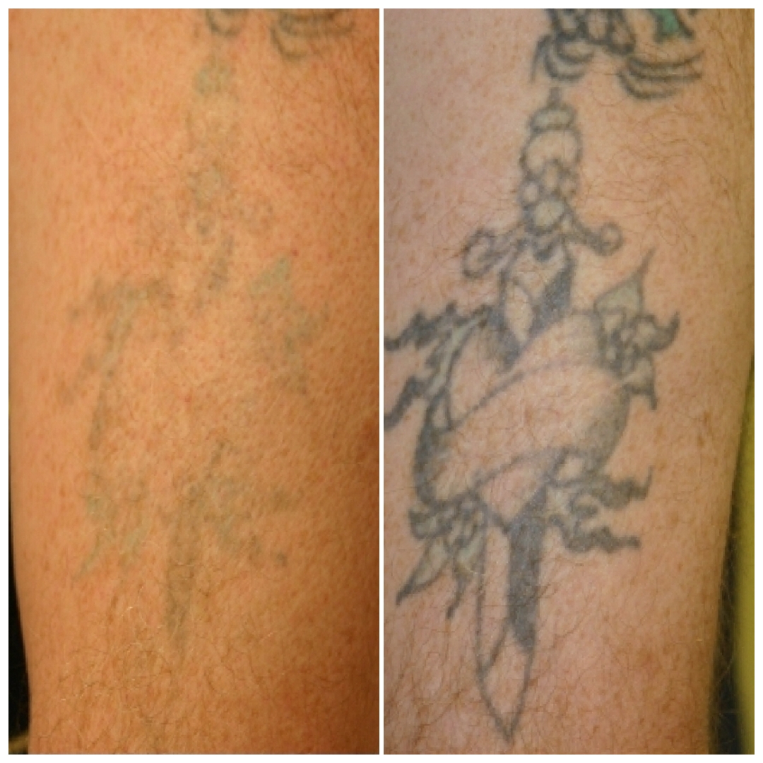 laser tattoo removal before and after
