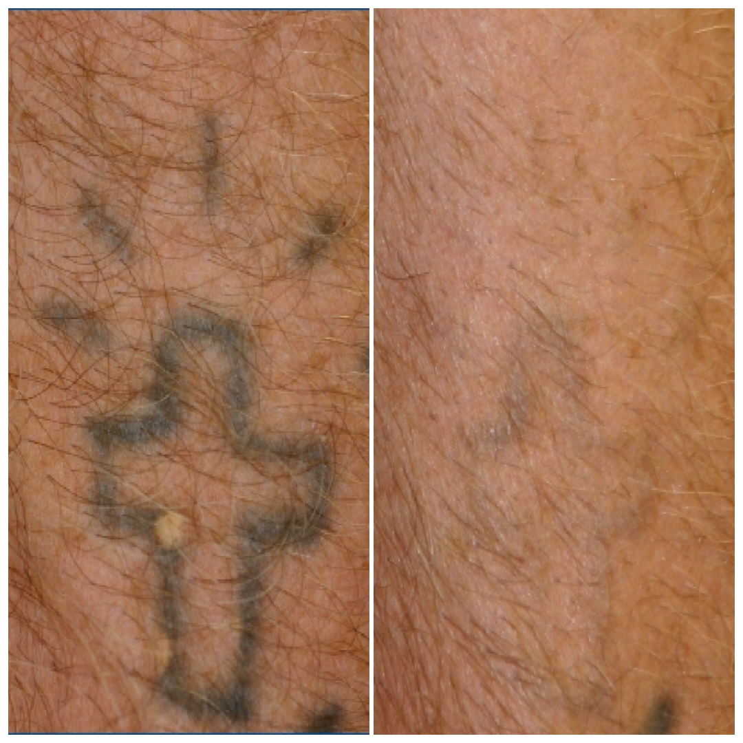 Tattoo removal