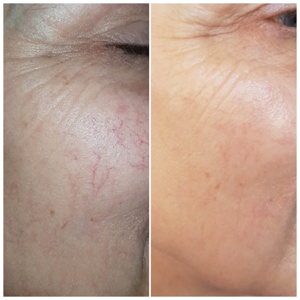 Laser Vascular Treatment