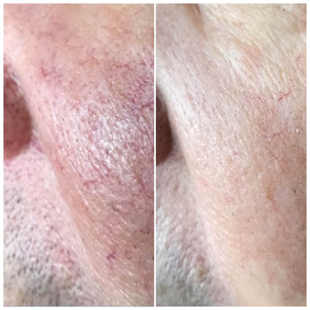 Laser Vascular Treatment