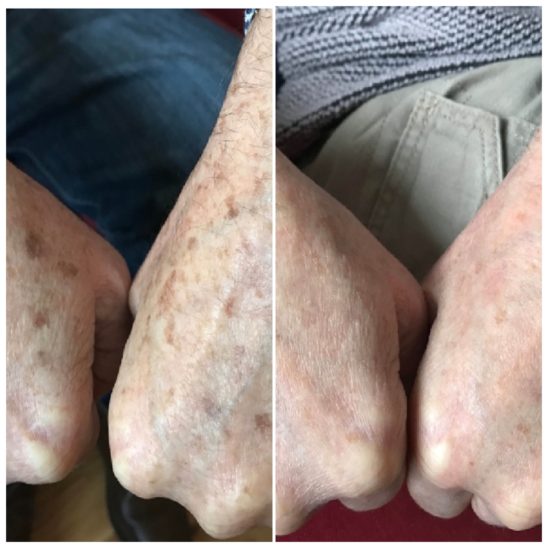 Laser Age Spot Removal Treatment