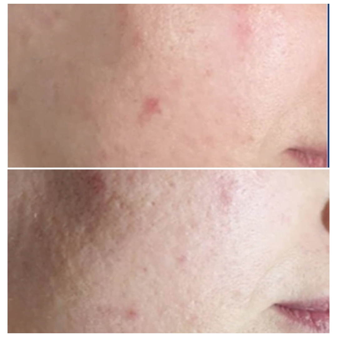 Facial Pigmentation treatment
