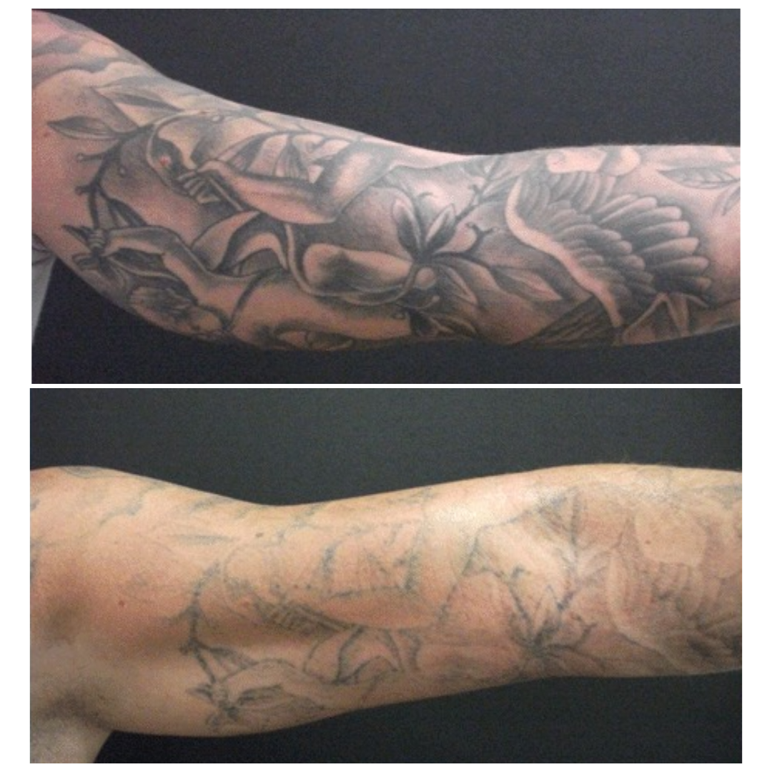 Laser tattoo Removal
