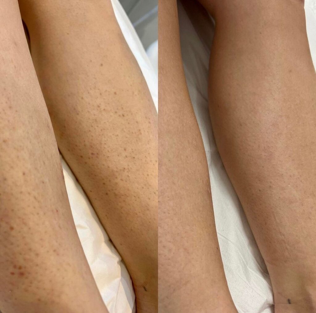 laser hair removal legs 