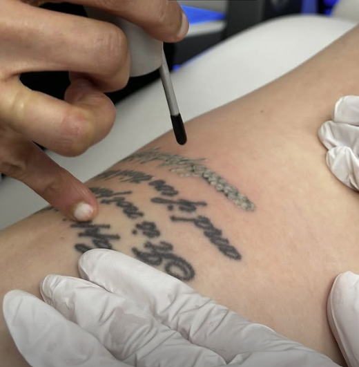 laser tattoo removal 