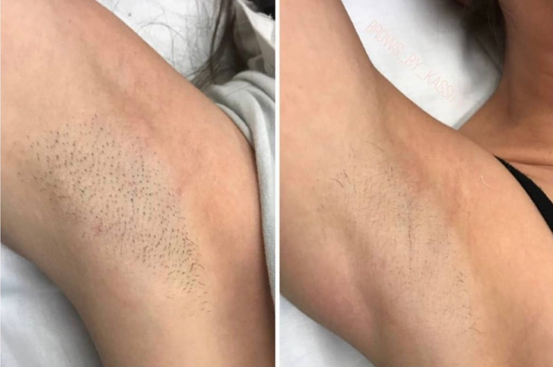 laser hair removal treatment 